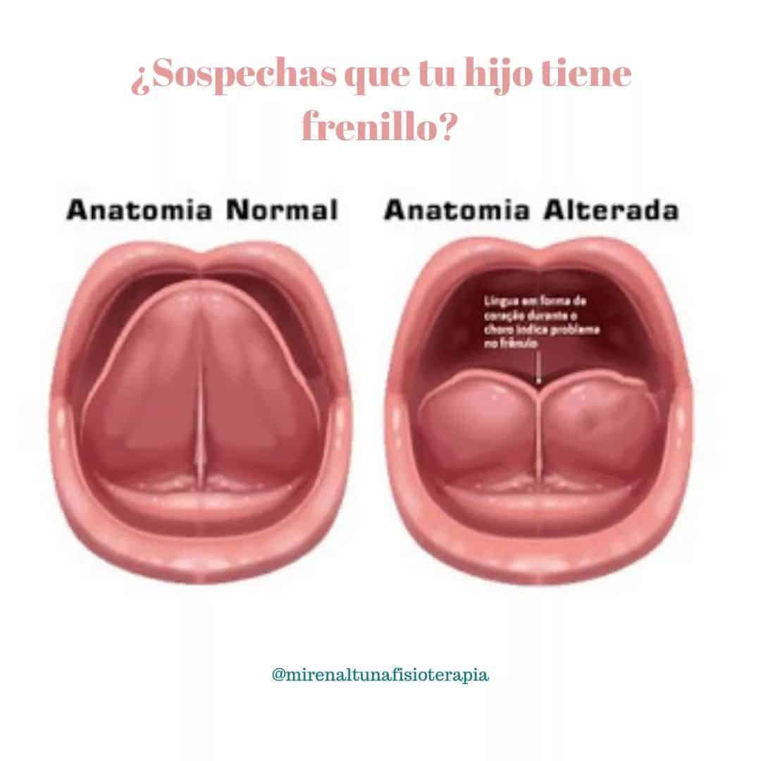  Qu Es El Frenillo Miren Altuna Fisioterapia